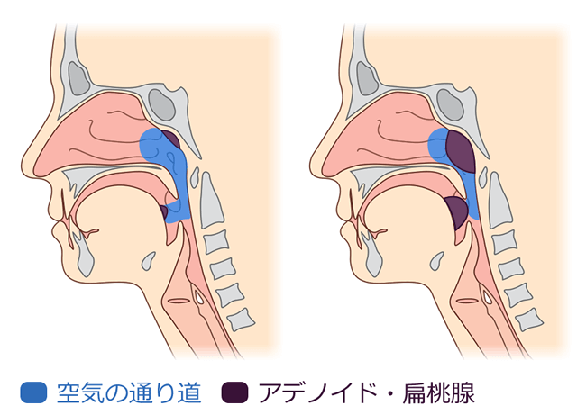 アデノイド・扁桃腺