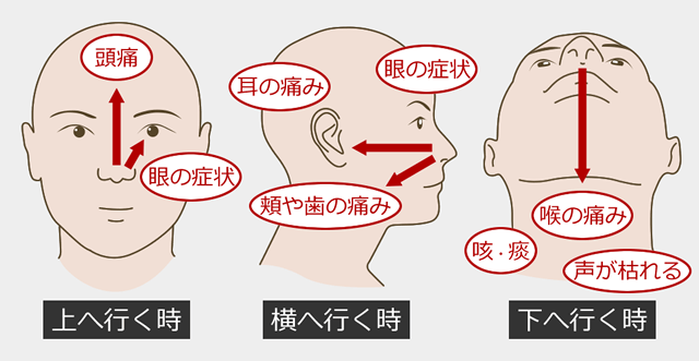 詰まり 頭痛 鼻